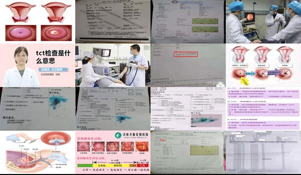 汕头hpv检查 - 汕头tct检查是查什么