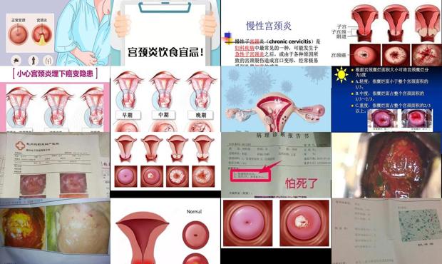 汕头宫颈炎