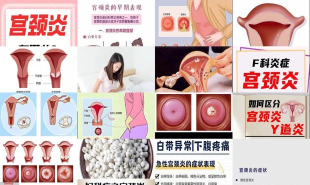 汕头宫颈炎的症状