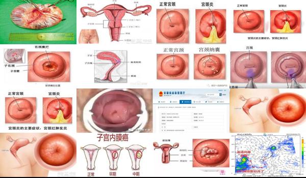 宫颈多发囊肿注意事项 - 汕头宫颈多发囊肿注意什么