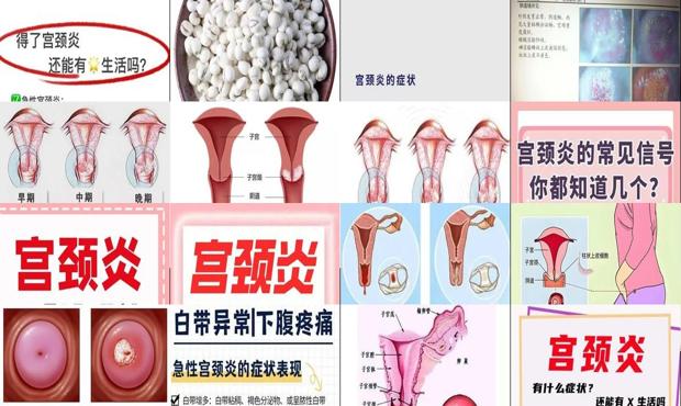 宫颈炎医院 - 汕头宫颈炎有哪些症状