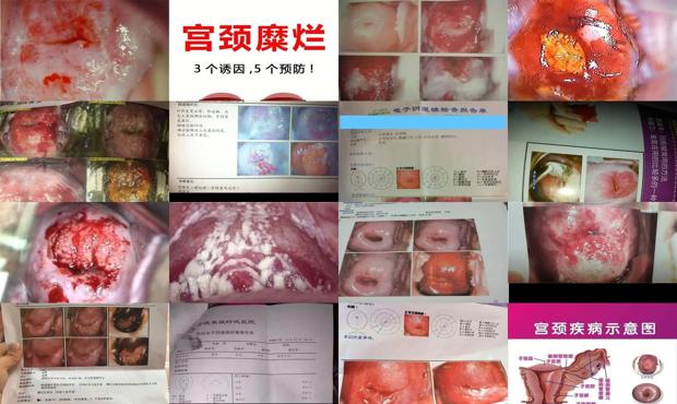 宫颈糜烂大概花多少钱 - 汕头宫颈糜烂的症状