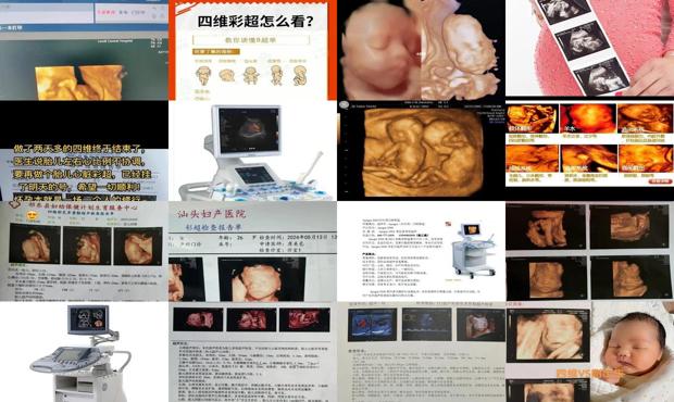 汕头市四维彩超哪个医院 - 汕头四维彩超的好处