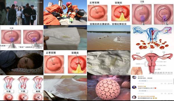 宫颈粘液是啥样 - 汕头宫颈粘液是什么样子的