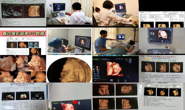 汕头四维彩超都检查什么
