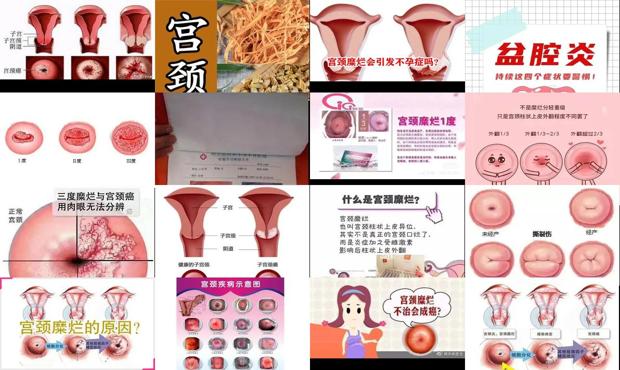 宫颈糜烂正规医院治疗方案 - 汕头宫颈糜烂 不孕不育