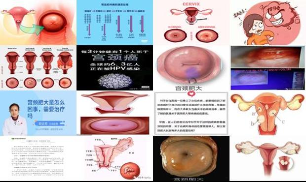 宫颈肥大需要治疗吗的短视频 - 汕头宫颈肥大是怎么回事