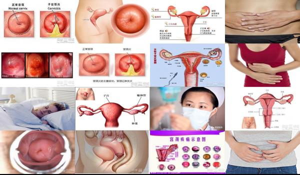 汕头慢性子宫颈炎症状有哪些 - 汕头慢性子宫颈炎症状