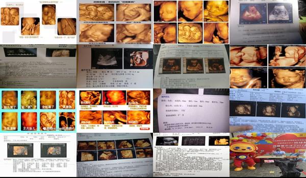 四维彩超提示潜在染色体异常 - 汕头四维彩超说胎儿潜在染色体异常指标