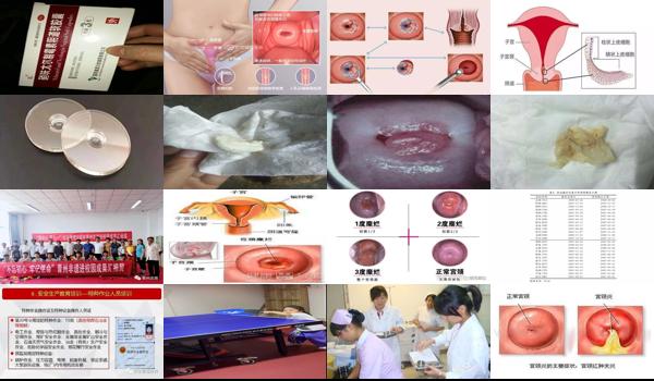 宫颈糜烂3度多少钱 - 汕头宫颈糜烂3度图