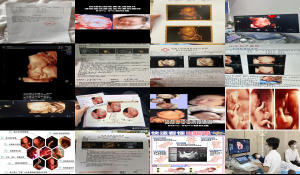 汕头四维彩超多少钱 - 汕头怀孕可以不做四维彩超吗