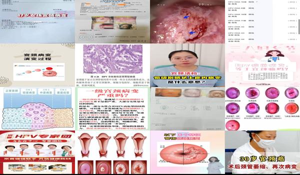 汕头宫颈病变是什么医院治疗 - 汕头宫颈病变是什么