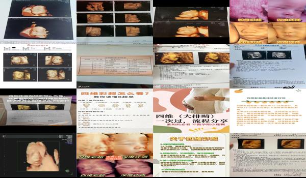 汕头四维彩超几个月能做完 - 汕头四维彩超几个月能做