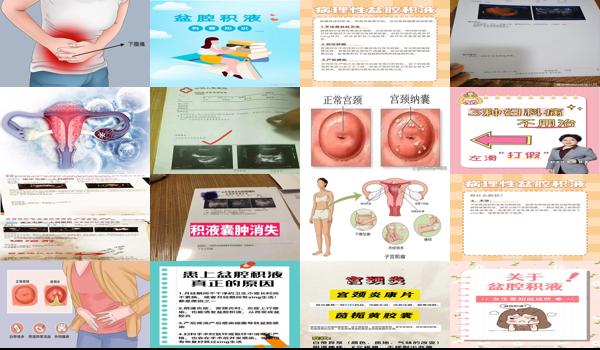 宫颈积液盆腔积液怎么治疗 - 汕头宫颈积水,盆腔积水是怎么回事
