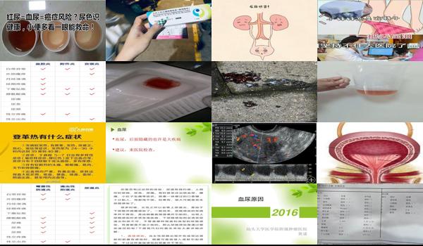 做完妇科检查后血尿 - 汕头妇科检查后血尿