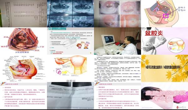 慢性盆腔炎去医院怎么检查 - 汕头慢性盆腔炎是怎么检查出来的