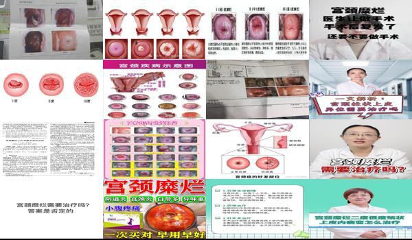 汕头宫颈糜烂治疗后会复发吗多少钱 - 汕头宫颈糜烂治疗后会复发吗