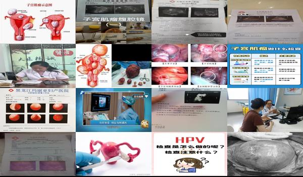 汕头市哪个医院做子宫肌瘤好 - 汕头子宫瘤需要做什么检查