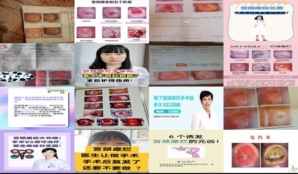 汕头哪个医院治疗宫颈癌好 - 汕头宫颈糜烂一定要手术吗