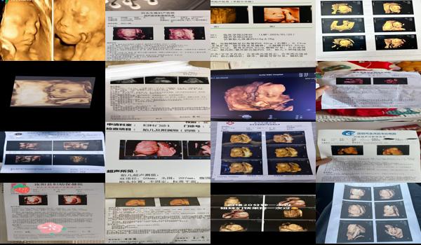 汕头四维彩超多少钱 - 汕头孕四维彩超