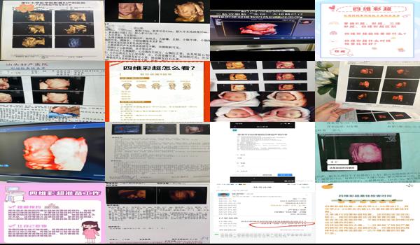 汕头四维彩超要预约吗多少钱 - 汕头四维彩超要预约吗