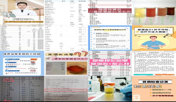 尿检的潜血是什么原因 - 汕头尿检查潜血什么意思