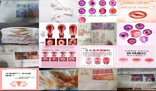 汕头宫颈糜烂充血治疗医院 - 汕头宫颈糜烂充血