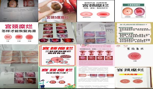 宫颈三度糜烂的症状有哪些 - 汕头宫颈三度糜烂症状